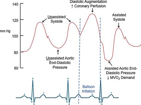 Intra Aortic Balloon Pump For High Risk Percutaneous Coronary