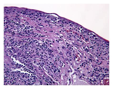 Left conjunctival biopsy with diffuse lymphocytic infiltrate ...