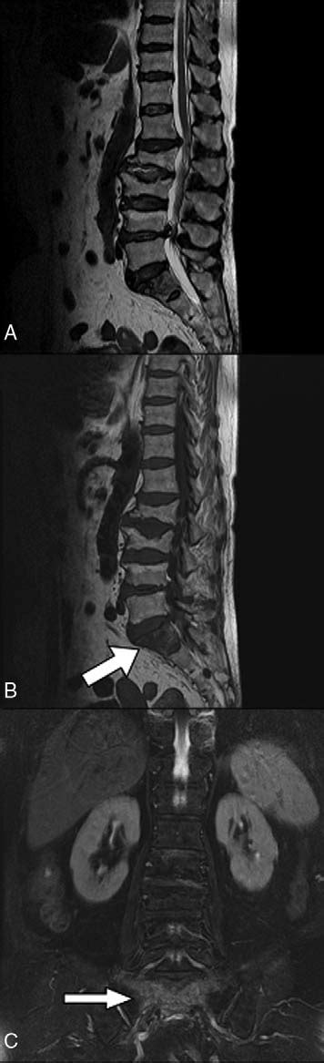 Mri A T1 Weighted Sagittal View B T2 Weighted Sagittal View And C