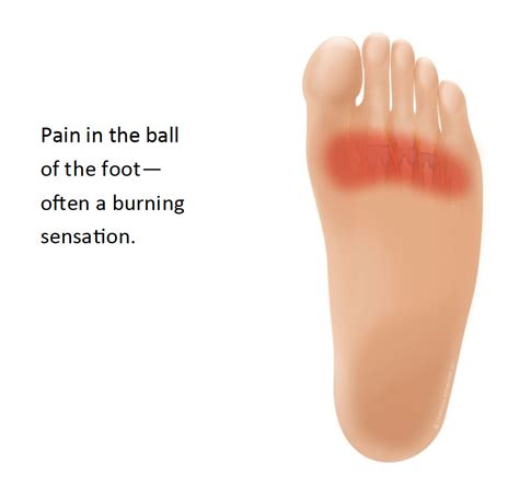 Swollen Ball Of Foot | Foot Pain Nhs – ZYKNPS