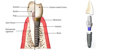 What is an Implant Abutment? | Mint Hill Dentistry