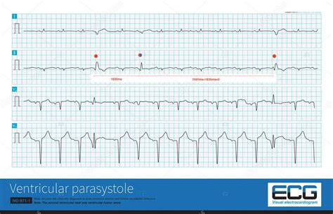 Un Paciente Con Infarto Agudo De Miocardio Present Tres Latidos