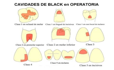 Caries Dentales ¿que Són Y Como Se Clasifican