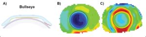 The Importance Of Corneal Topography In Orthokeratology For Myopia