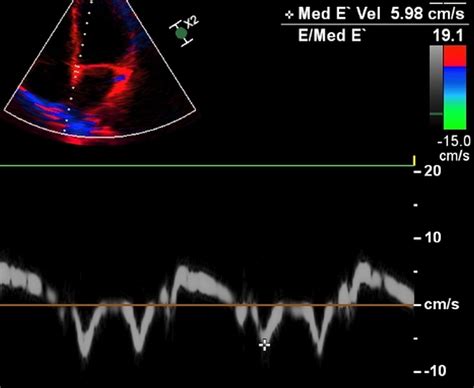 Doppler and tissue Doppler in left ventricular diastolic dysfunction – All About Cardiovascular ...