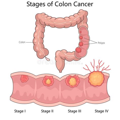 Colon Cancer Stages Diagram Medical Science Stock Illustration ...