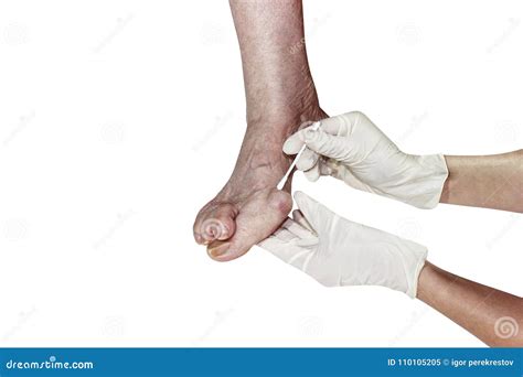 Medecin Valgus Bunion Leg With Deformation Valgus Hallux Bunion