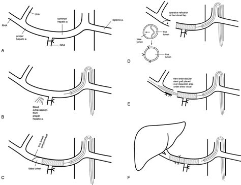 Illustration Of Modified Vortec Procedure Performed In Our Surgery