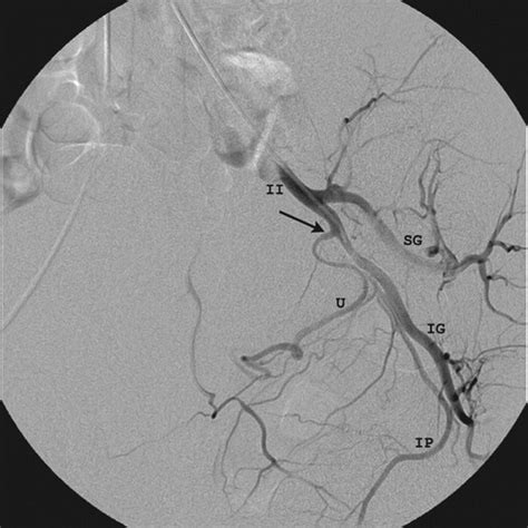 Uterine Artery Embolization Optimization With Preprocedural Prediction