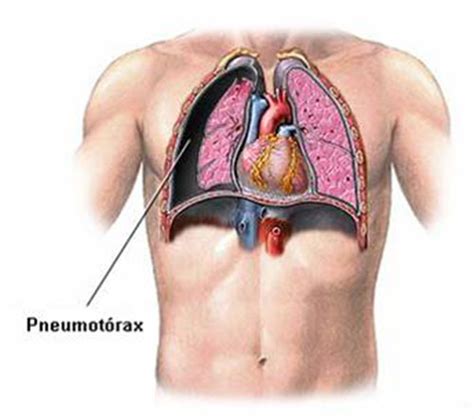 O que é Pneumotórax Tratamento Tipos Sintomas Cura e Mais