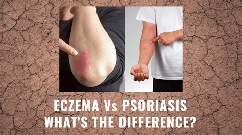 Eczema vs Psoriasis What's The Difference – Hanna Sillitoe