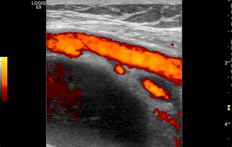 Iliopsoas Bursitis Ultrasound