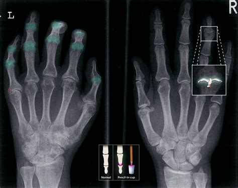 Psoriatic Arthritis Pencil In Cup Psoriatic Arthritis Pencil In Cup