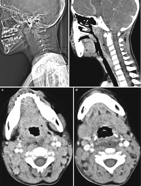 Mucocutaneous Lymph Node Syndrome Pictures