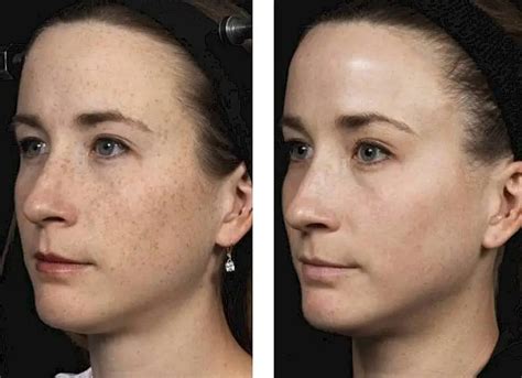 Fraxel Laser Treatments Nyc And Nj Schweiger Dermatology