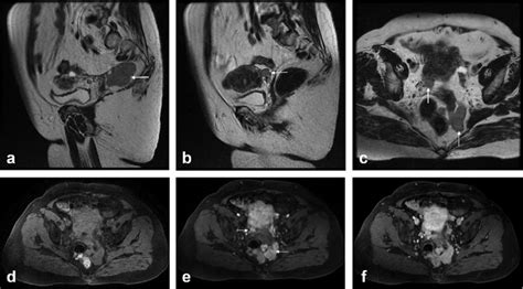 Sagittal A B And Transverse C Fast Spin Echo T Weighted Images