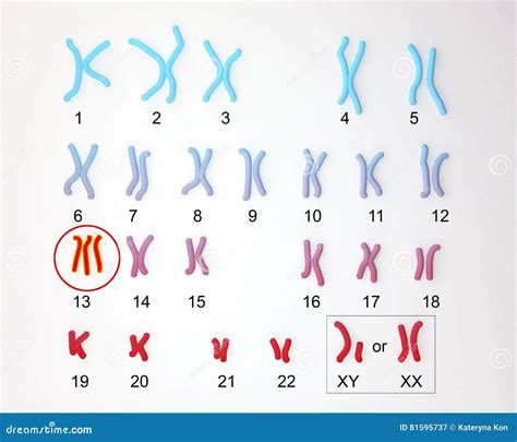 Patau-syndrome karyotype stock illustration. Illustration of microscope ...