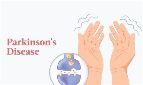 The Essential Guide To Parkinsons Disease Symptoms Causes Treatments And Natural Remedies