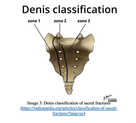 EmDOCs Net Emergency Medicine EducationEM 3AM Sacral Fractures