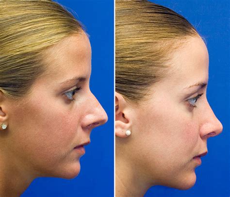 projected long nose rhinoplasty seattle facial plastic