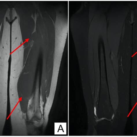 A Sagittal MRI Section Showing Low Signal Intensity On T1W Imaging In