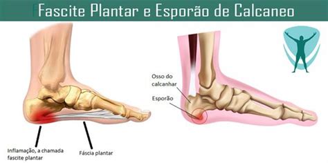 Fascite Plantar E Esporão É A Mesma Coisa