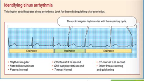 Arrhythmia Strips Flashcards Quizlet