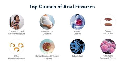 Anal Fissure Surgery Anal Fissure Laser Treatment In Chennai