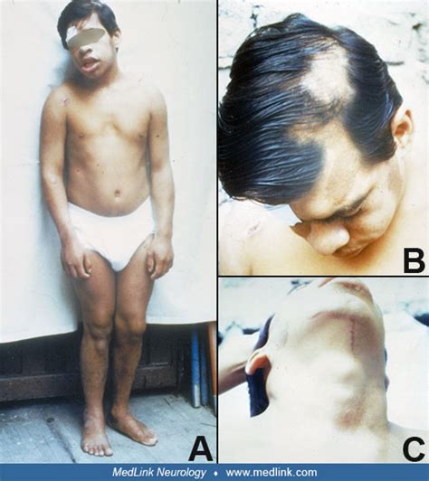 Epidermal nevus syndrome (ENS) | MedLink Neurology