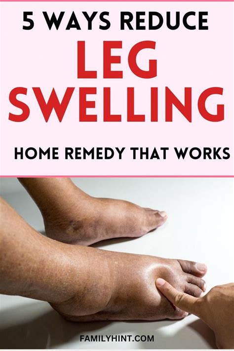 5 Natural Leg Swelling Remedies That Work Fast Artofit