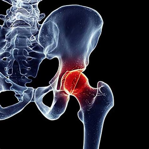 hip osteoarthritis  symptoms diagnosis treatment dr naftulin