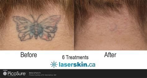 Picosure Toronto Laser Tattoo Removal Laserskin Ca