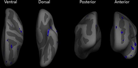 P2437 MEASURING CORTICAL THICKNESS AND LOCAL GYRIFICATION INDEX IN