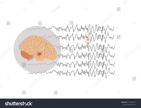 vektor stok vector illustration human brain abnormal brain