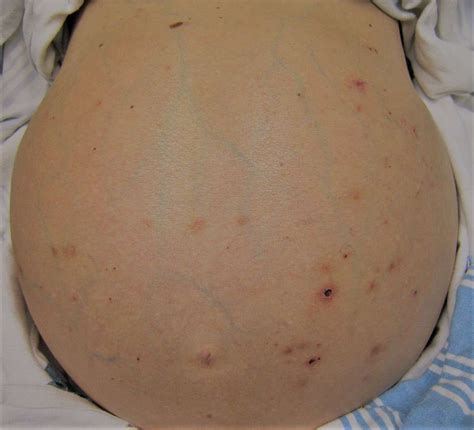 Ascites Pictures