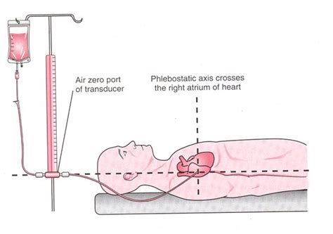 Phlebostatic Axis And Everything Cardiac Nurse Anesthesia Nursing