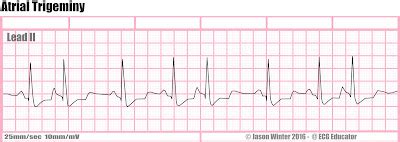 ecg educator blog atrial trigeminy
