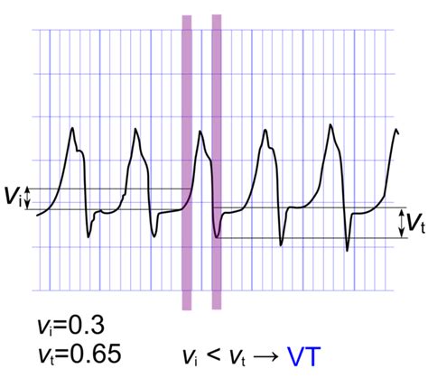 Wide Complex Tachycardia Differential Diagnosis Wikidoc