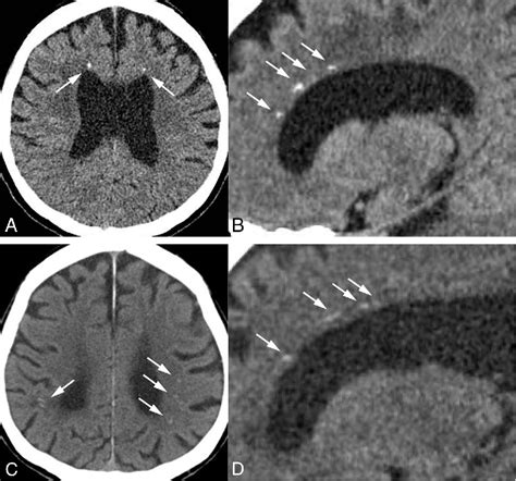 Figure 3 From Adult Onset Leukoencephalopathy With Axonal Spheroids And