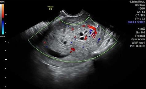 Hydatidiform Mole Meaning Causes Signs Symptoms Diagnosis And Treatment