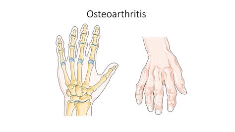 Arthritis Nodules Explained: Symptoms, Causes, and Treatment For 2025