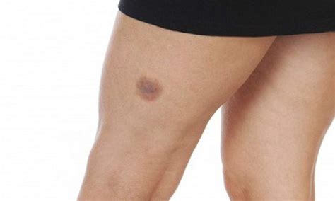 Mancha Roxa Na Coxa O Que Pode Ser - Mancha roxa pode ser problema vascular. Saiba a hora de procurar um médico