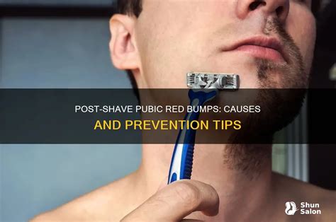 4 Simple Strategies To Erase Those Icky Post-Shave Bumps