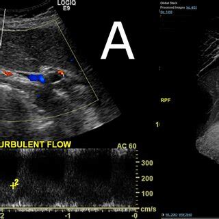 Renal artery Doppler and magnetic resonance angiogram Doppler ...