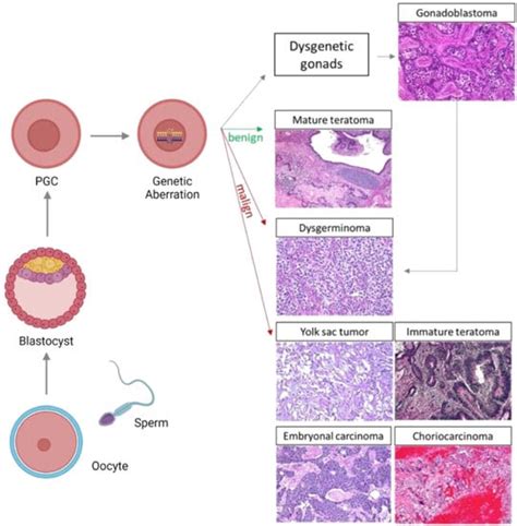 Etiopathogenesis Of Ovarian Germ Cell Tumors Encyclopedia Mdpi