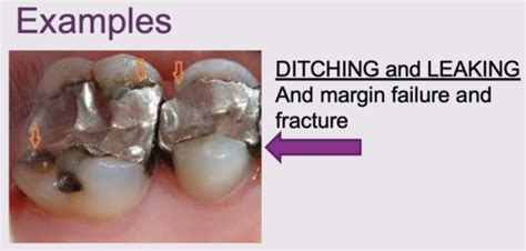 repair replacement failure  restorations flashcards quizlet