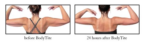 Liposuction Recovery Week By Week Cosmetic Skin Laser Center