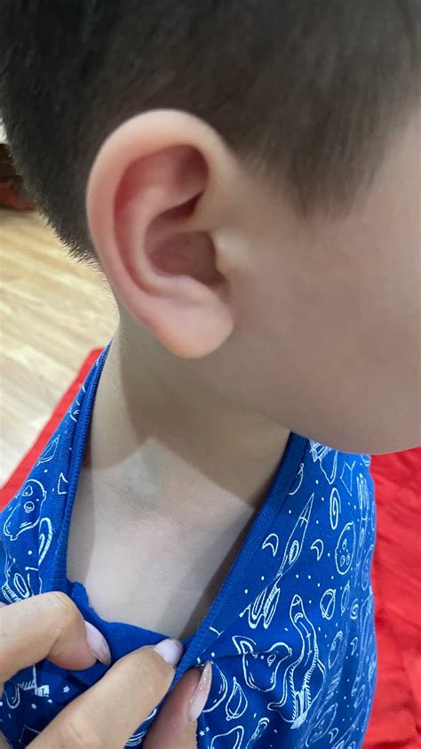 На шеи у ребёнка скопление синих вен - Вопрос детскому хирургу - 03 Онлайн