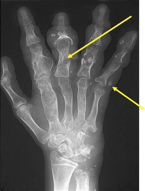 Enchondroma Benign Bone Tumor Tumors Of Bone