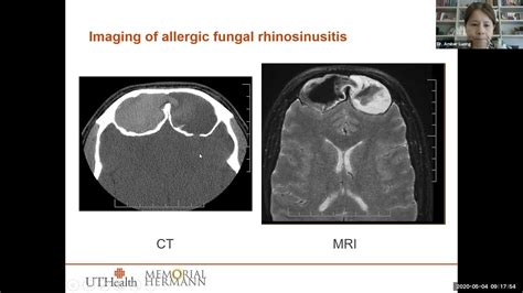 Allergic Fungal Rhinosinusitis Dr Amber Luong YouTube